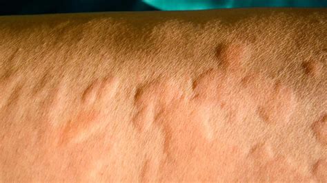 common skin rashes