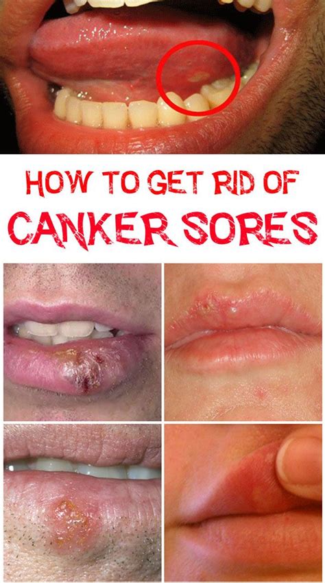 Canker Sore On Tongue Pictures Causes And Treatments - vrogue.co