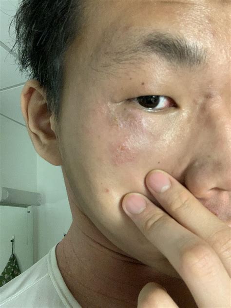 I have a rash under my eye but it’s not eczema, and the area is swollen