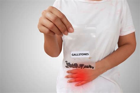 Diagnosis and Treatment of Gallstones | Sydney Gut Clinic