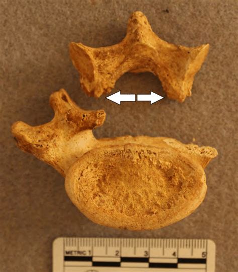 Spondylolysis in L5 (inferior view); young-adult female from Korti ...