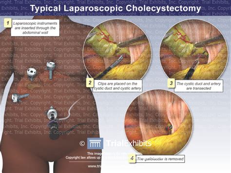 Typical Laparoscopic Cholecystectomy - TrialQuest Inc.