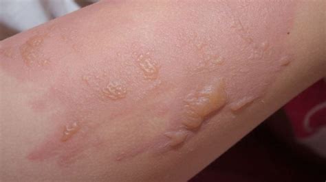 Severe Burns Archives - Rare