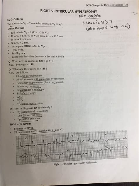 Left Ventricular Hypertrophy Ecg 2