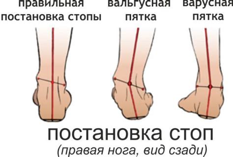 Типы деформации стопы. | Мягкие ткани, Здоровье, Здоровье и красота