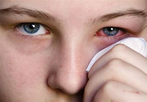 Як розпізнати вірусний кон'юнктивіт? Симптоми захворювання* | ВолиньPost