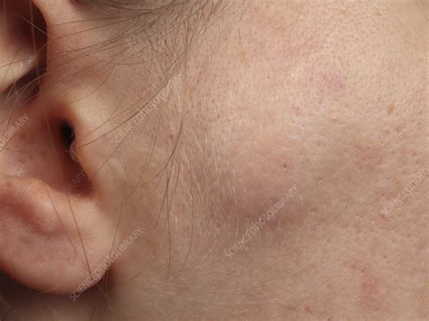 Sebaceous cyst - Stock Image - C057/9241 - Science Photo Library