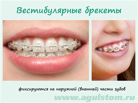 Исправление прикуса брекетами до и после фото в профиль