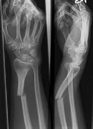 Open and Closed Fractures - Anatomy: Fracture Tutorial