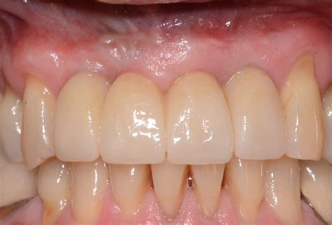 Dental Implants | Pacific Spirit Dental, Vancouver