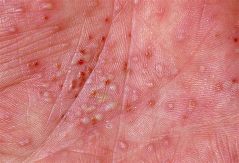 Eczema Rash On Hands And Feet at Mark Cox blog