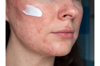 Купить Ducray KERTYOL Pso ежедневный увлажняющий бальзам в аптеке