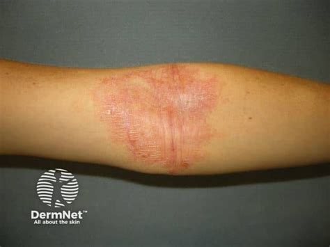 Atopic flexural eczema images