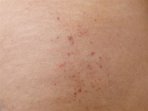 skin petechiae stock   royalty  stock