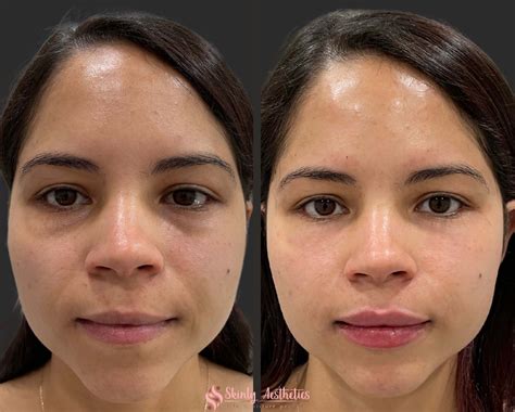 Lip Filler Before & After Results - Skinly Aesthetics