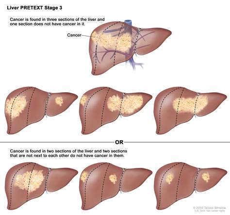 Liver Cancer Stages | MedicineBTG.com