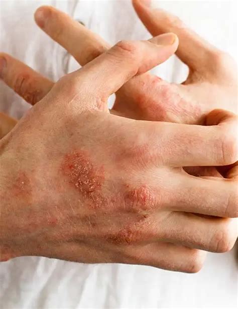 Eczema Treatment Store | cityofclovis.org