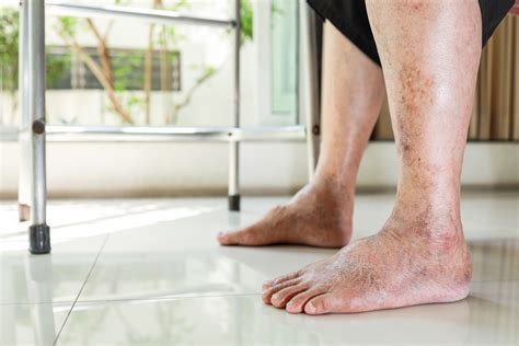 What is Peripheral Artery Disease | AE