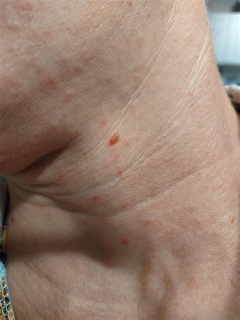 Vitamin D deficiency rash? itchy bumps : r/VitaminD