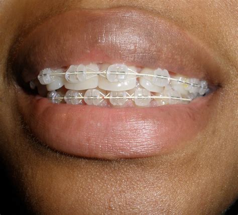 mai musings   front teeth