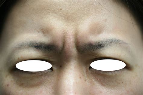 眉間のしわが寄る方で眉毛が動きやすい方、眉ハネボトックスも併用するのがおすすめです。 | 医学博士・六本木スキンクリニック院長 鈴木稚子 ...