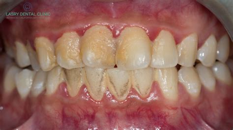 dental plaque  gayla wilson blog