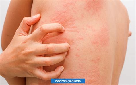 Alerji • Hekimim Yanımda