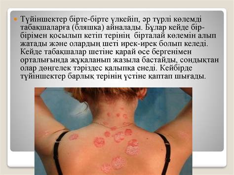 Псориаз - презентация онлайн