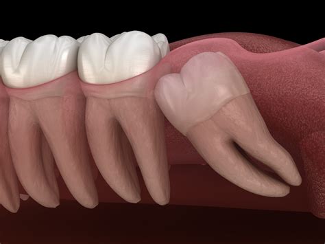 Remover Dente Do Siso - Extração dos Dentes do Siso | Odontomania