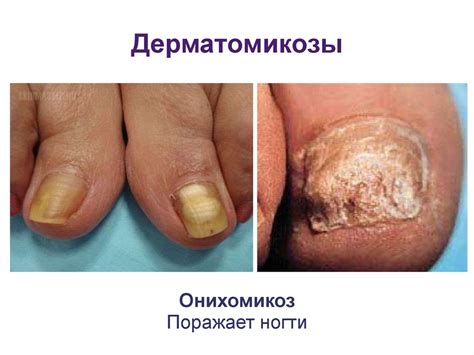 Грибковые заболевания - презентация онлайн
