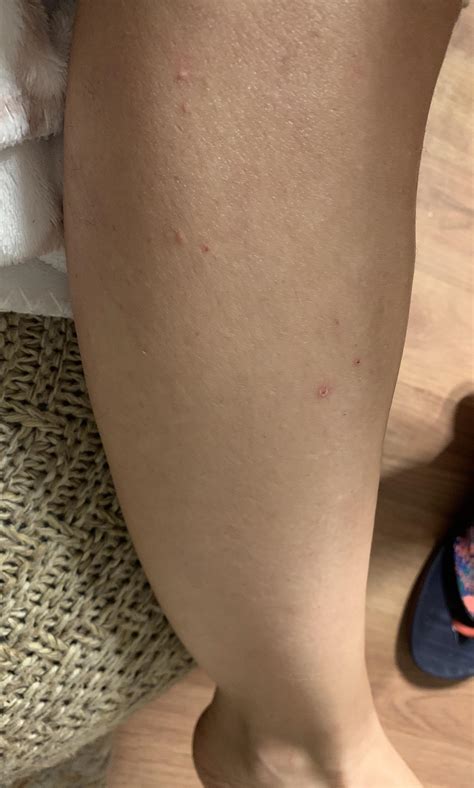 Tips for fading post inflammatory hyperpigmentation marks from legs
