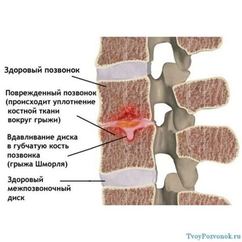 Грыжа Шморля поясничного отдела позвоночника: лечение, симптомы ...