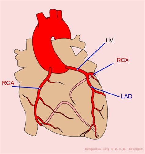 Ischemie - ECGpedia