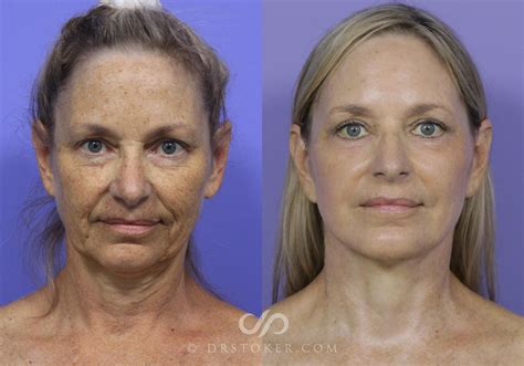 Facelift before and after – Artofit