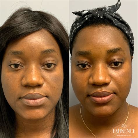 Clear & Brilliant Results | Princeton, Montgomery NJ Eminence