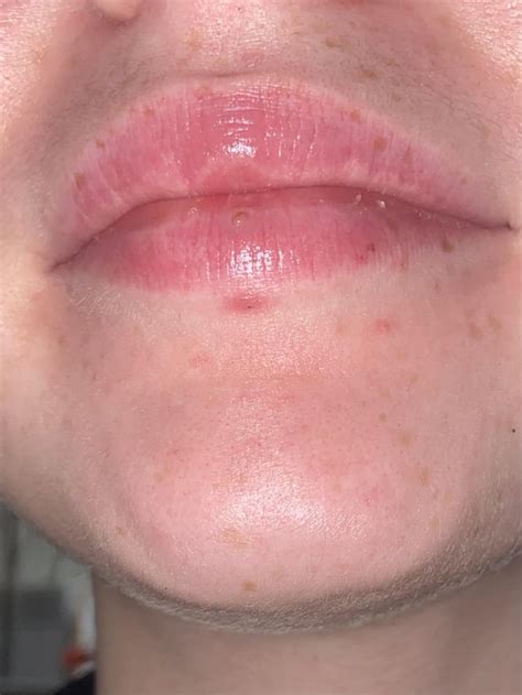 took my vertical labret out, how can i minimize scarring? : r ...