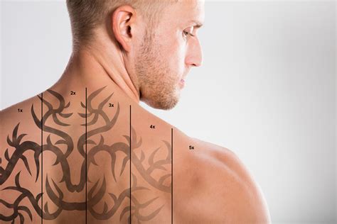 Tattoo Removal • Hawaii Dermatology And Plastic Surgery Centers