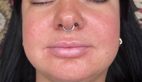 Expert Dermal Fillers / Lips Augmentation in Maryville, TN