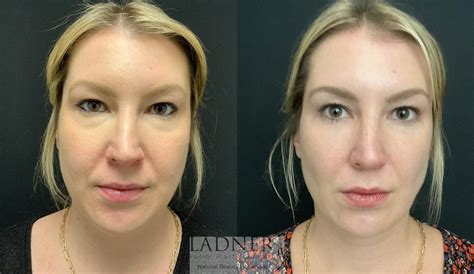 Facial Fat Transfer: Before and After | Keith Ladner, MD