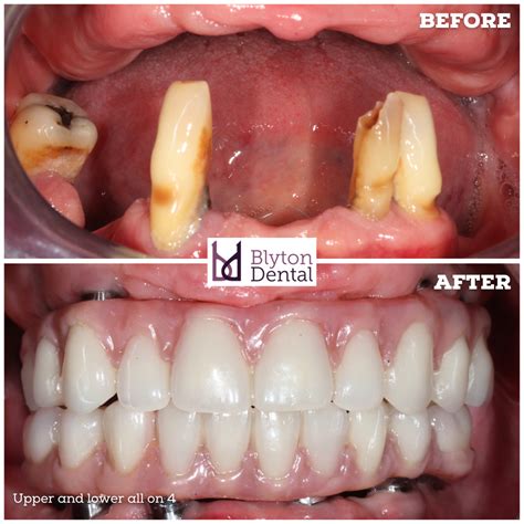 Upper and lower all on 4 — Blyton Dental