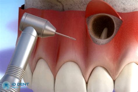 Резекция верхушки корня зуба в Киеве – цена гранулемэктомии в ID Dent