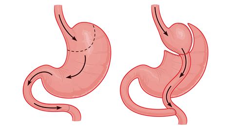 Bypass Gastric în Y: de la 122 kg la 79,5 kg în 6 luni | Arcadia ...