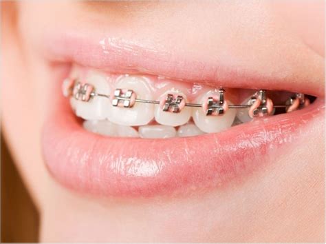 AAO Offers Guidance for Orthodontic Care During the COVID-19 Outbreak ...