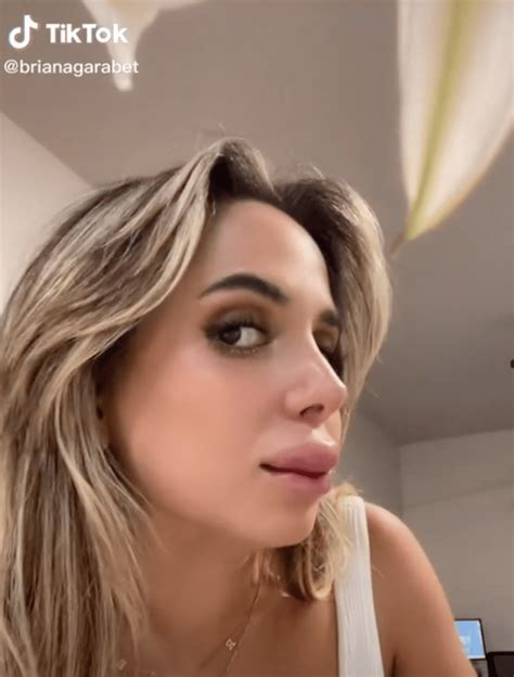 Una tiktoker muestra el llamativo resultado de un relleno de labios