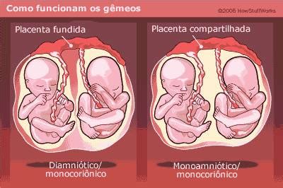 Gêmeos Da Mesma Placenta E Bolsas Diferentes São Idênticos - Tipos de gêmeos e trigêmeos | Os Trigêmeos da Michele