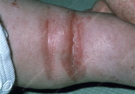 Close-up of atopic eczema in bend of child's leg - Stock Image - M150 ...