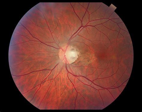 Optic Disc Detection Matlab Code 6