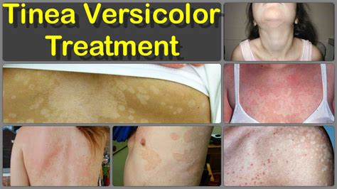 Tinea Versicolor Symptoms Causes And Treatment - vrogue.co