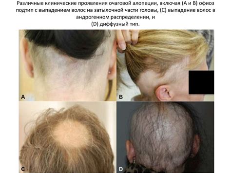 Гнездная алопеция - online presentation