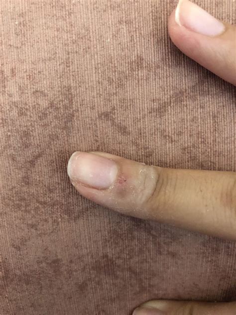 Is this a wart? I had thicker skin around my fingernail, applied SA on